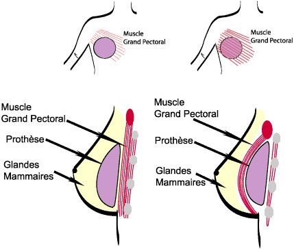 prothese mammaire devant le muscle marseille