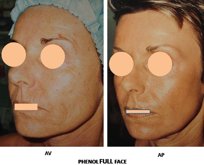 Peeling Phenol Full Face