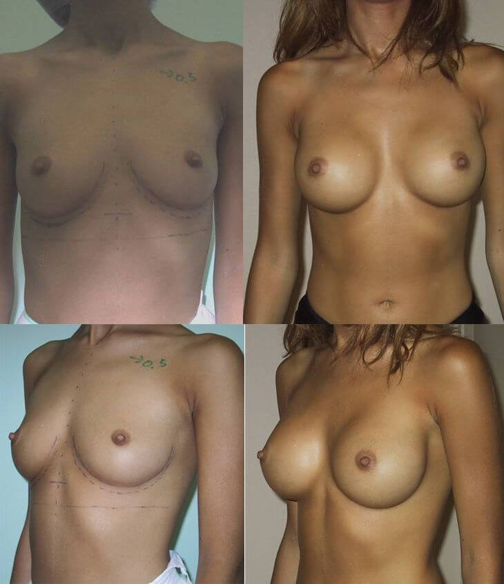 Implant sans cicatrice sur les seins