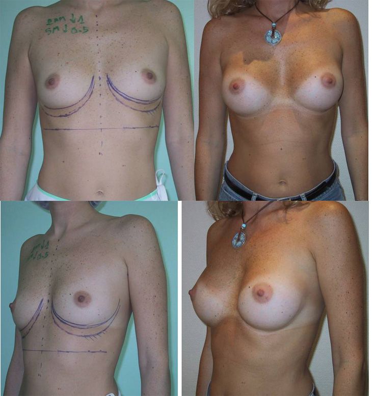 Augmentation mammaire par voie axillaire