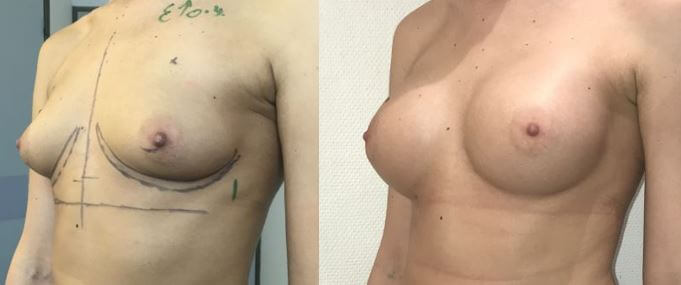 Implants mammaires anatomiques rétromusculaire  310cc x2 -Augmentation de volume mammaire modérée