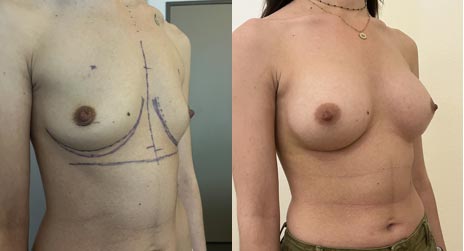 Implants mammaires anatomiques sans cicatrice (juin 2023)