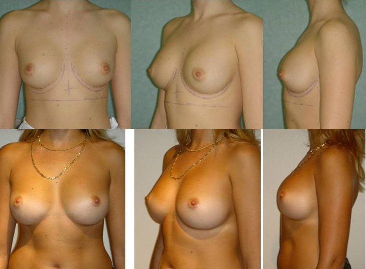 Prothèse de seins par voie axillaire