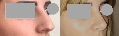 Rhinoplastie - Affinement et relèvement de la pointe du nez (décembre 2020)