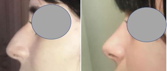 Rhinoplastie - Suppression de la bosse et allégement de la pointe du nez (janvier 2021)
