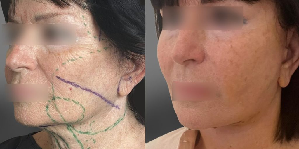 face-lift-bichectomie-et-resection-cordes-cervicales-a-6-jours-post-op-1-trois-quart