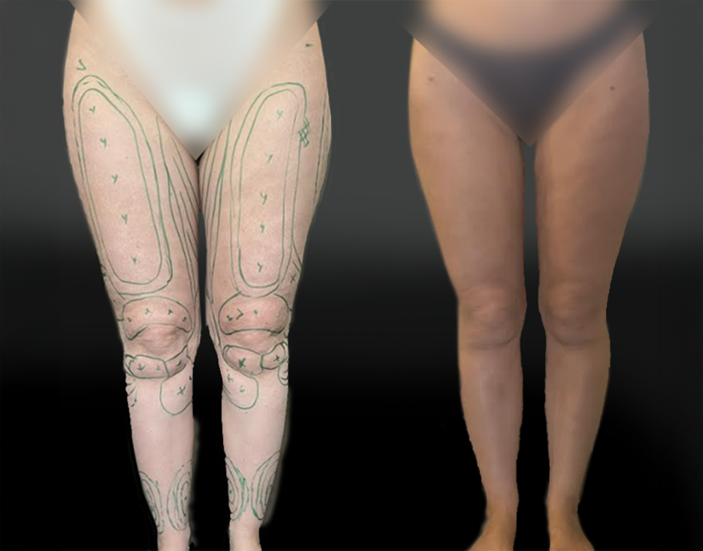 lipoaspiration-etendue-des-membres-inferieurs-1-face