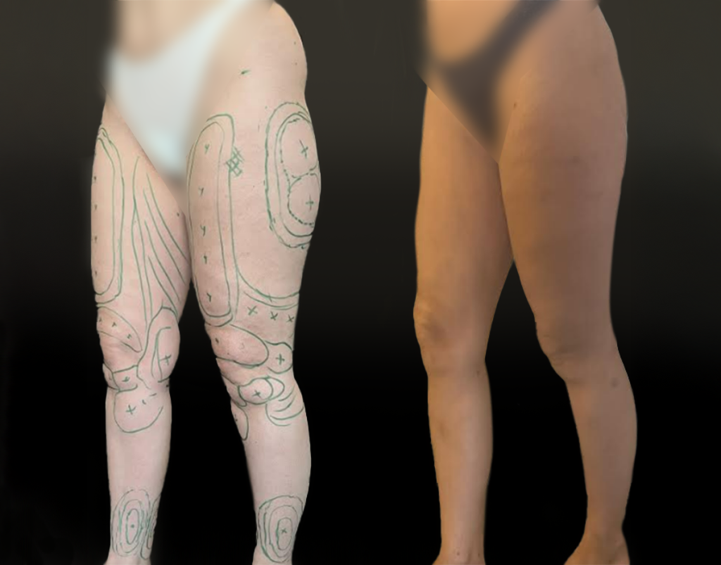 lipoaspiration-etendue-des-membres-inferieurs-1-profil