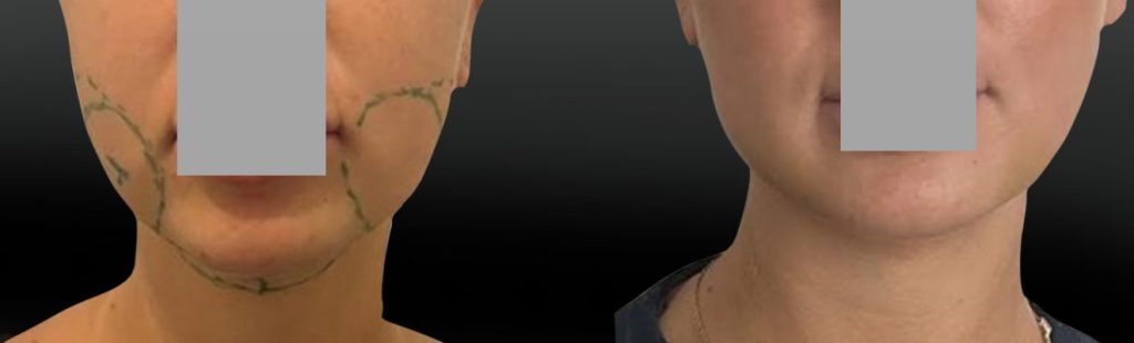Lipoaspiration joues ovale et cou