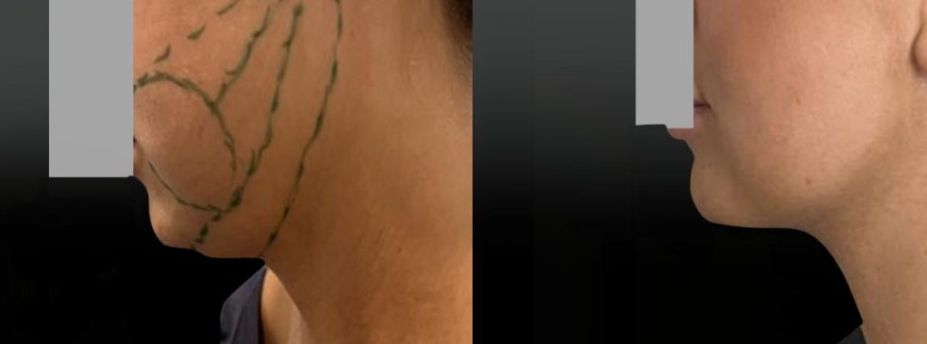 Lipoaspiration joues ovale et cou