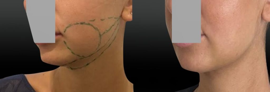 Lipoaspiration joues ovale et cou