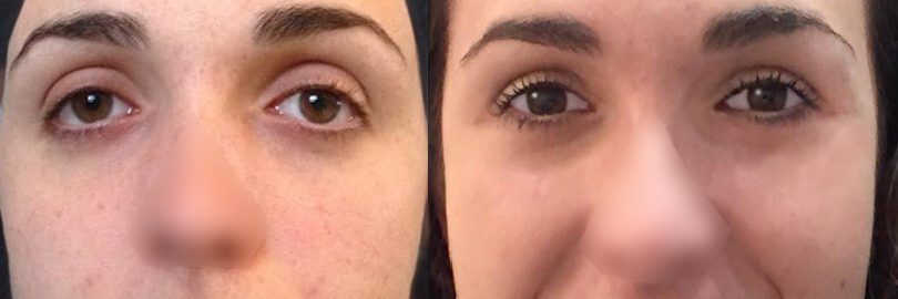mask-lift-avec-canthopexie-trans-osseuse-1