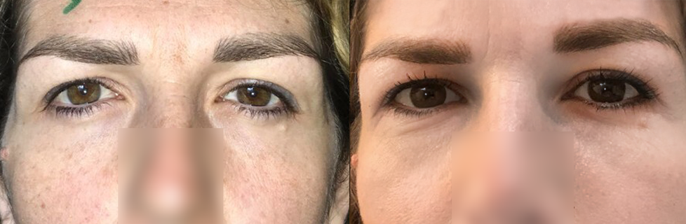 mask-lift-avec-canthopexie-trans-osseuse-2