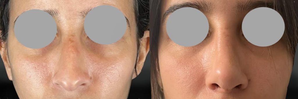 Rhinoplastie à 3 semaines post opératoire