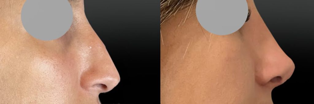 Rhinoplastie à 3 semaines post opératoire