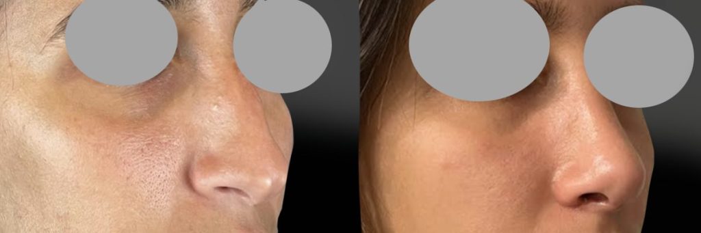 Rhinoplastie à 3 semaines post opératoire