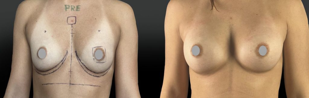 Implants mammaires en-position pré musculaire pour patiente sportive avec de gros pectoraux