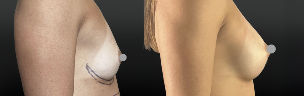 Implants mammaires en-position pré musculaire pour patiente sportive avec de gros pectoraux