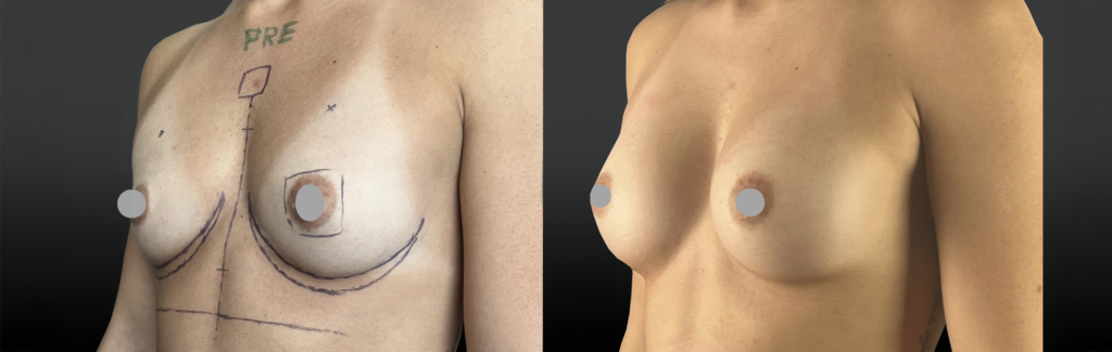 Implants mammaires en-position pré musculaire pour patiente sportive avec de gros pectoraux