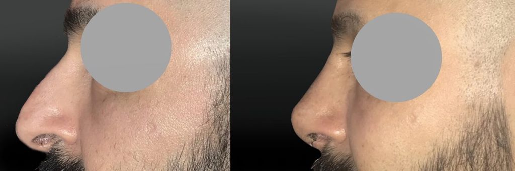 Rhinoplastie Homme
