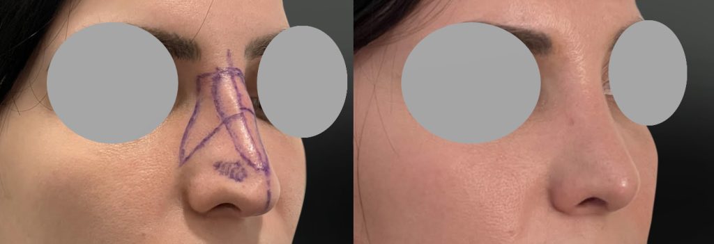 Affinement global du nez (Décembre 2025)