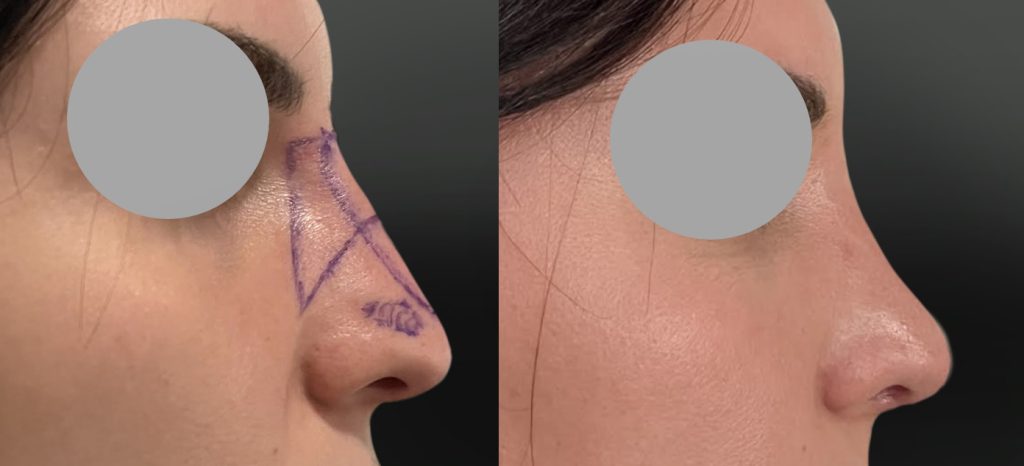 Affinement global du nez (Décembre 2025)