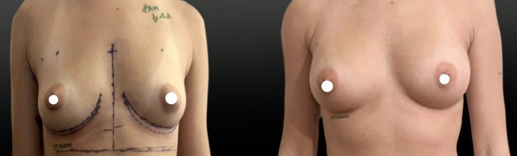 Implants anatomiques afin de corriger les creux sus-mammaires tout en respectant une augmentation modérée