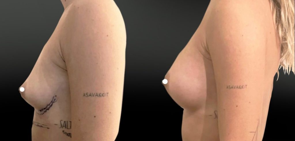 Implants anatomiques afin de corriger les creux sus-mammaires tout en respectant une augmentation modérée