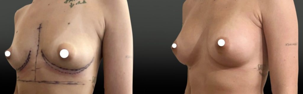 Implants anatomiques afin de corriger les creux sus-mammaires tout en respectant une augmentation modérée