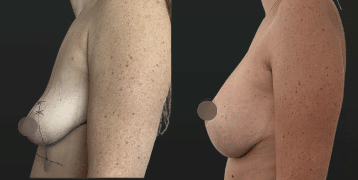 Plastie mammaire pour ptose avec implants Marseille - Profil (Février 2026)
