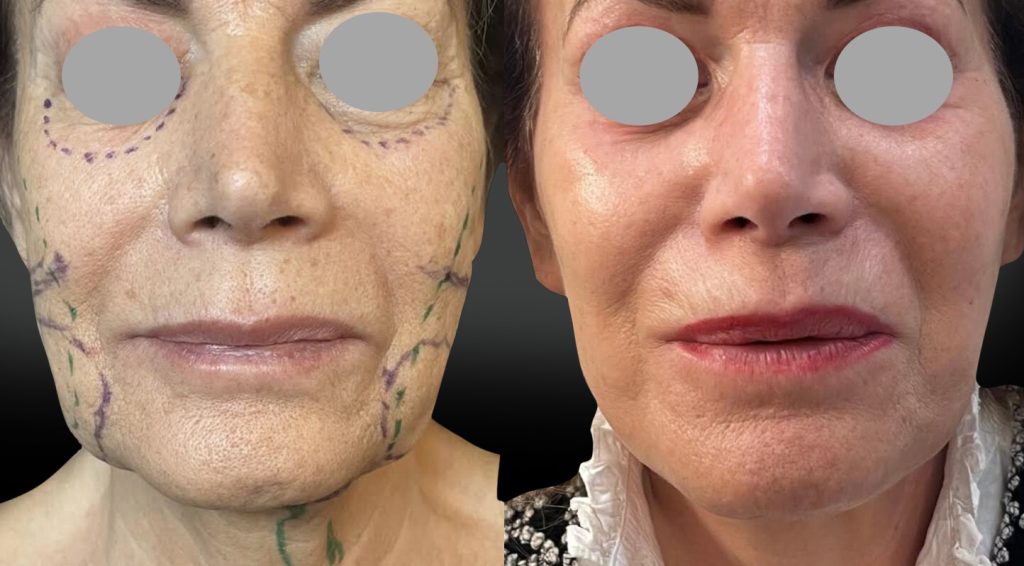 Face lift joues ovale cou avec résection des boules graisseuses de Bichât à 4 mois, réalisé avec ma technique personnelle de plicature basse et étendue du SMAS (vue face)
