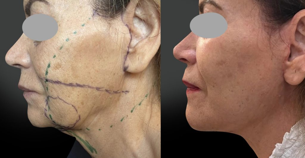 Face lift joues ovale cou avec résection des boules graisseuses de Bichât à 4 mois, réalisé avec ma technique personnelle de plicature basse et étendue du SMAS (vue profil)