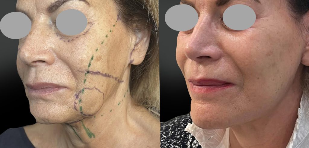 Face lift joues ovale cou avec résection des boules graisseuses de Bichât à 4 mois, réalisé avec ma technique personnelle de plicature basse et étendue du SMAS (vue 3/4)