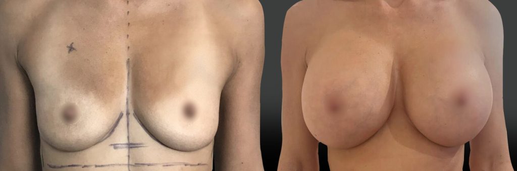 implants-mammaire-marseille-face-mars26