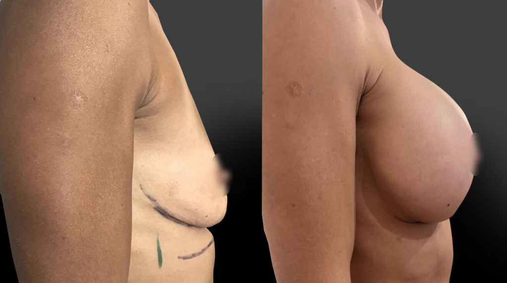 implants-mammaire-marseille-profil-mars26