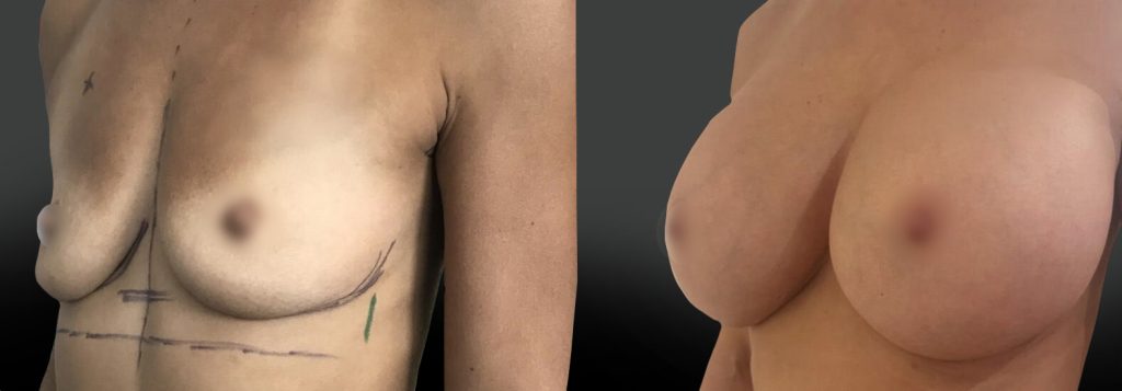 implants-mammaire-marseille-tiers-mars26