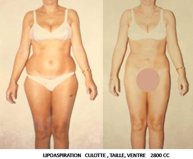Lipoaspiration culotte taille et ventre (2800cc)