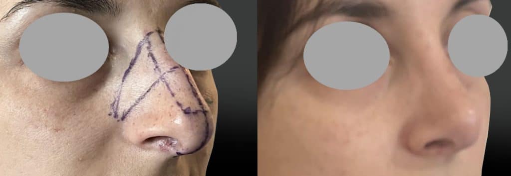 Rhinoplastie de réduction avant-après