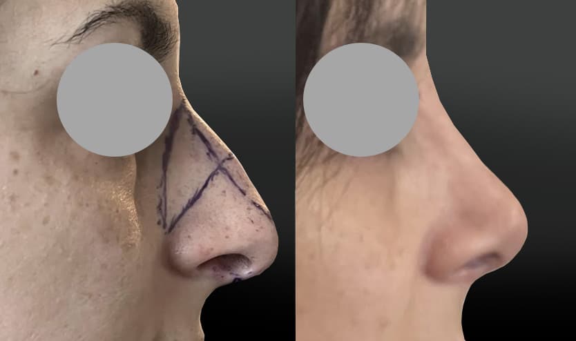 Rhinoplastie de réduction avant-après