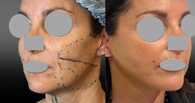 Face lift + Bichectomie et résection cordes cervicales à 6 jours post op (septembre 2025)