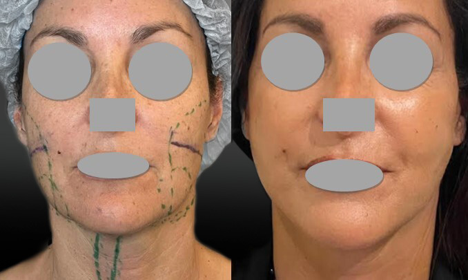 Face lift + Bichectomie et résection cordes cervicales à 6 jours post op (septembre 2025)