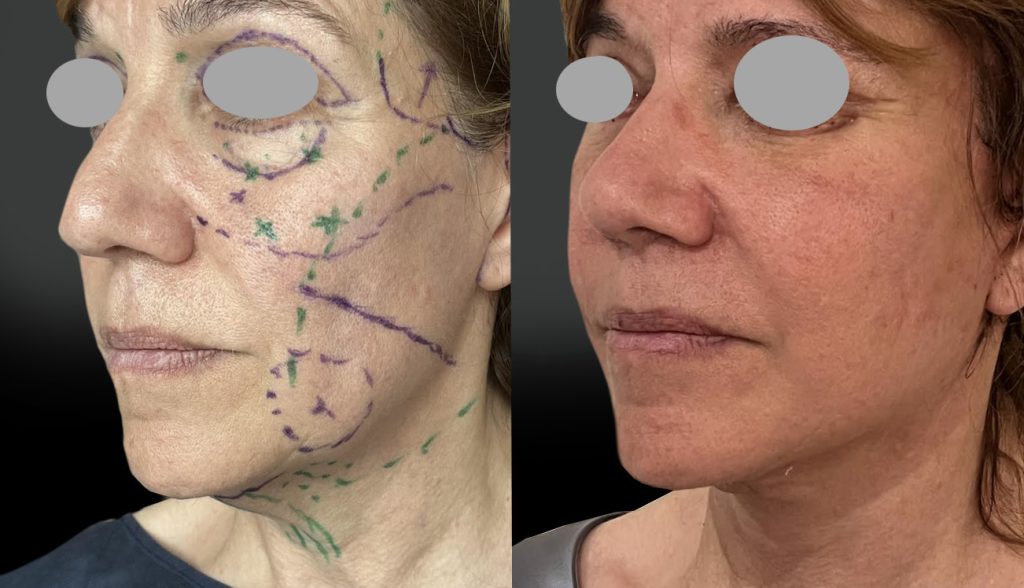 Lift joues, ovale, cou, centro-facial, tempes, Bichats, paupières supérieures et inférieures, lipoaspiration du cou et résection de 2 fanons. Au 10ème jour post-op. (mai 2026)
