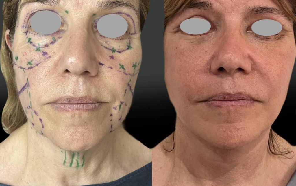 Lift joues, ovale, cou, centro-facial, tempes, Bichats, paupières supérieures et inférieures, lipoaspiration du cou et résection de 2 fanons. Au 10ème jour post-op. (mai 2026)