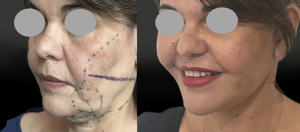 Lifting centro facial associé au Low Extended Smas Plication (lifting musculo cutané profond) (Mai 2026)