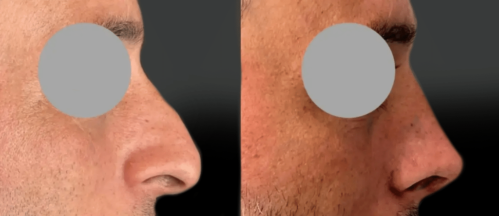Rhinoplastie Homme à Marseille (juin 2026)