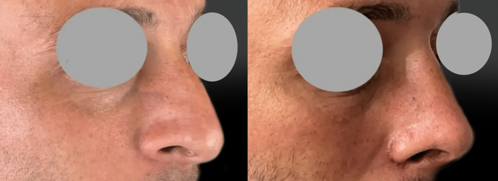 Rhinoplastie Homme à Marseille (juin 2026)